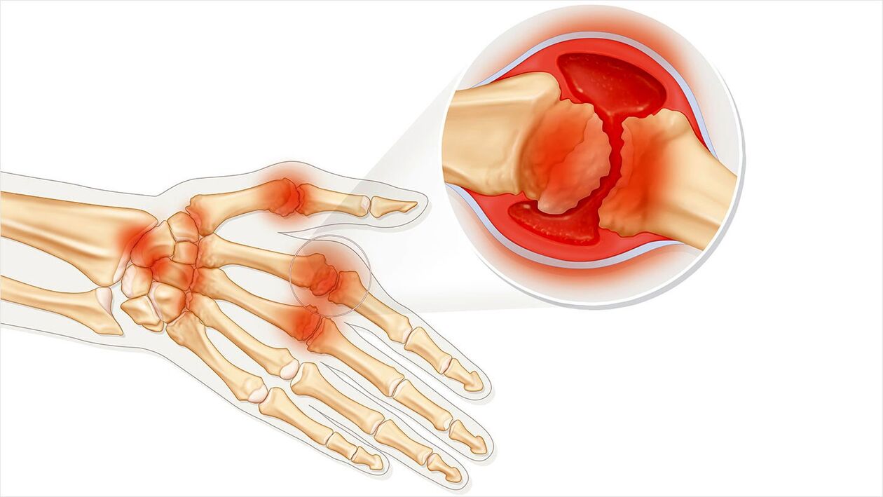 Osteoartrite da trattare con Traugel