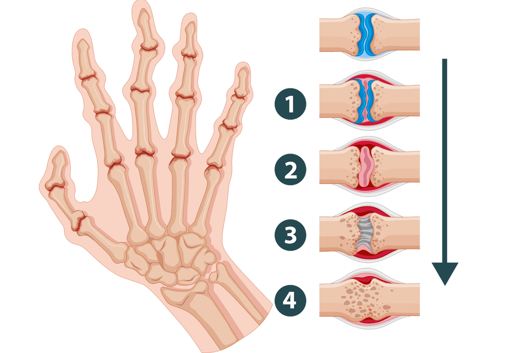 Stadi di sviluppo dell'artrite – danno articolare infiammatorio