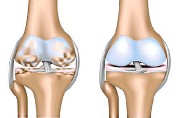 Articolazioni sane e osteoartrite