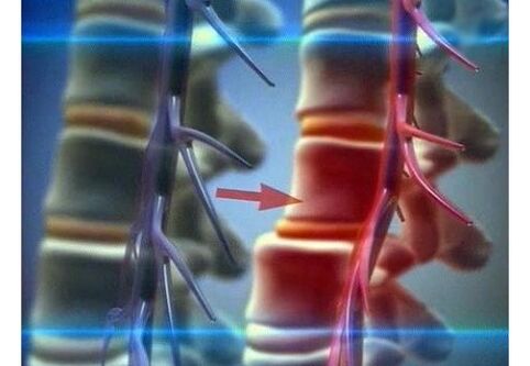 Compressione delle terminazioni nervose nell'osteocondrosi lombare