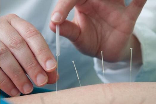 L'agopuntura è un metodo per trattare il dolore lombare causato dall'osteocondrosi