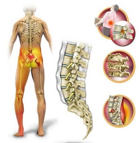 Osteocondrosi della colonna lombare, che causa dolore nella parte bassa della schiena