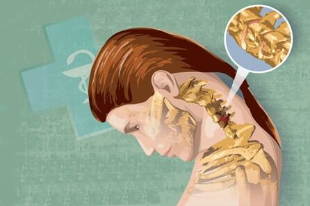 Sintomi riflessi dell'osteocondrosi