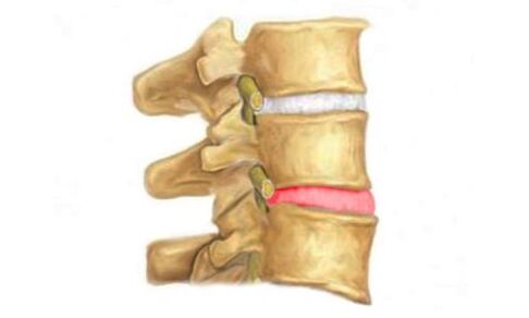 Rigonfiamento del disco intervertebrale della colonna vertebrale - un segno di osteocondrosi