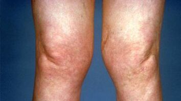 Deformità delle articolazioni del ginocchio con artrosi