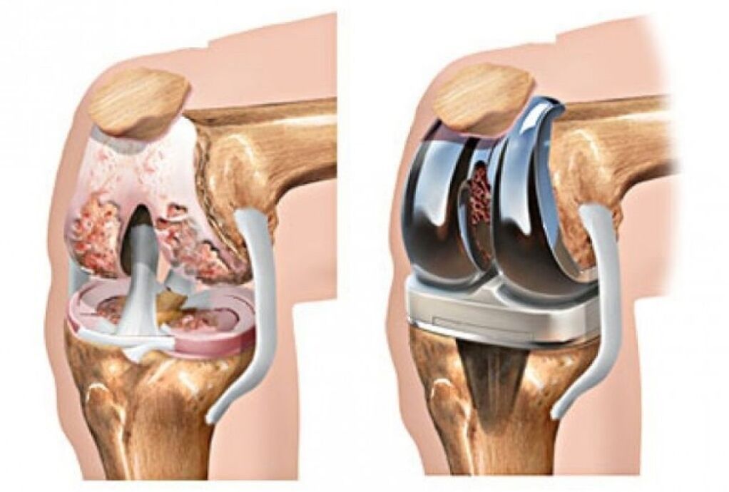 L'artroplastica del ginocchio nell'osteoartrosi