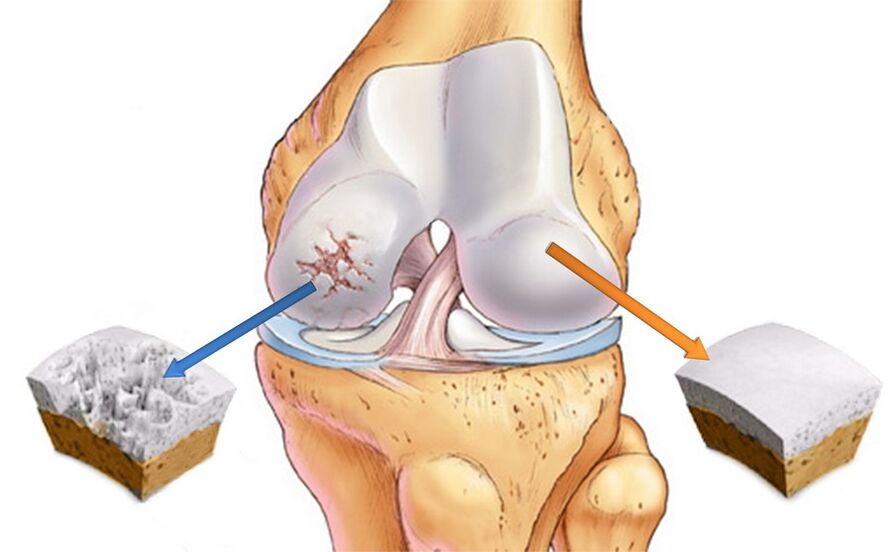 Articolazione del ginocchio sana (a destra) e affetta da artrosi (a sinistra)