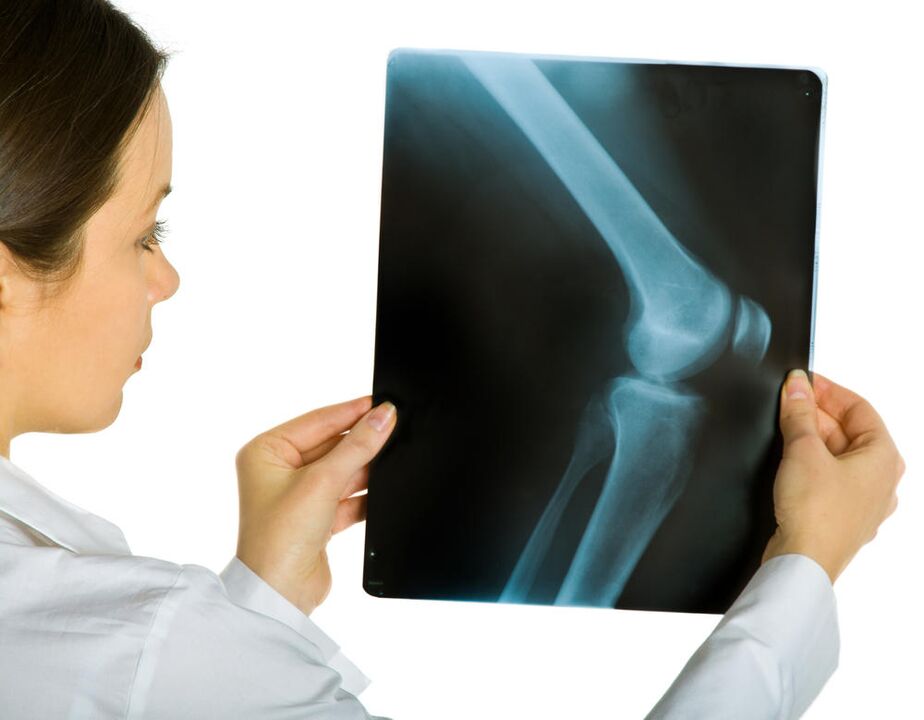 Una radiografia dell'articolazione del ginocchio mostra la presenza di artrosi deformante